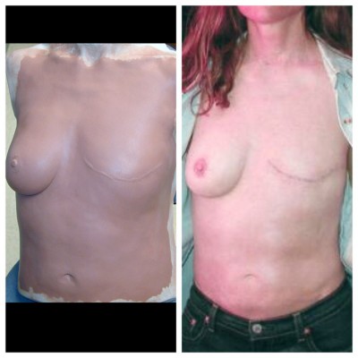 mastectomy