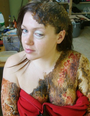 Burns Victim - Bodies BBC3a.jpg