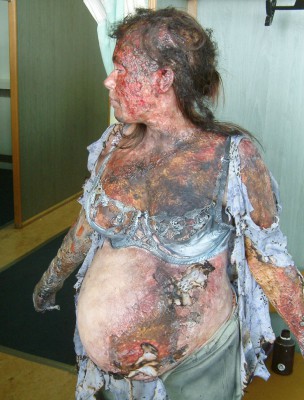 Burns Victim - Bodies BBC3b.jpg