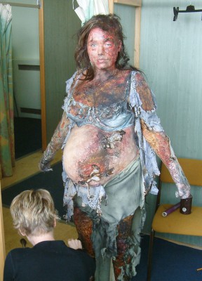 Burns Victim - Bodies BBC3c.jpg